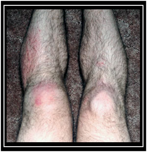 Arlos swollen left knee... sexy.